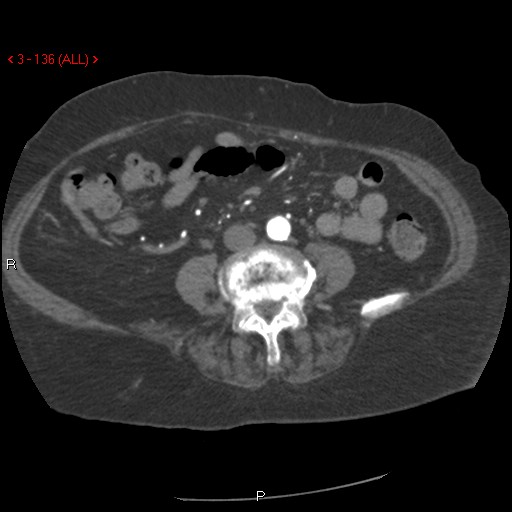 Aortic intramural hematoma (Radiopaedia 27746-28001 A 136).jpg