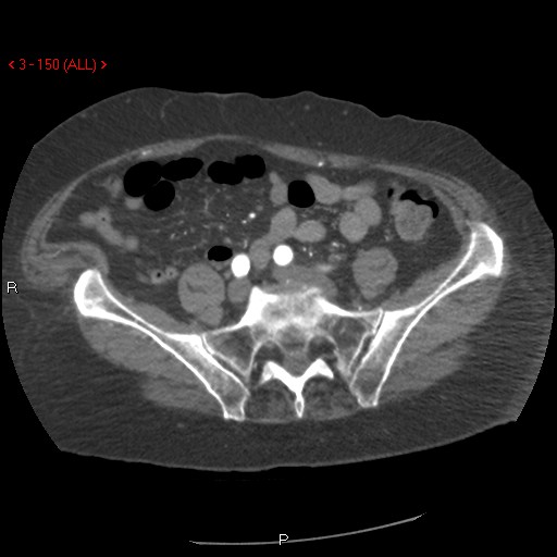 File:Aortic intramural hematoma (Radiopaedia 27746-28001 A 150).jpg