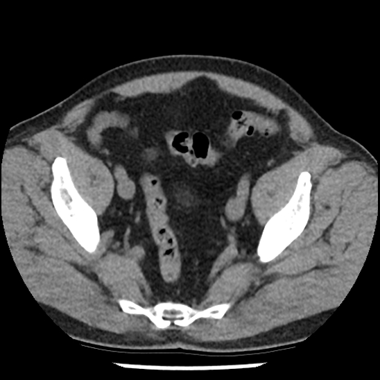 Aortic intramural hematoma (type B) (Radiopaedia 79323-92387 Axial non-contrast 101).jpg