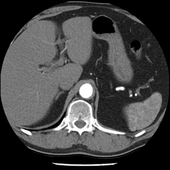 Aortic intramural hematoma (type B) (Radiopaedia 79323-92387 B 55).jpg
