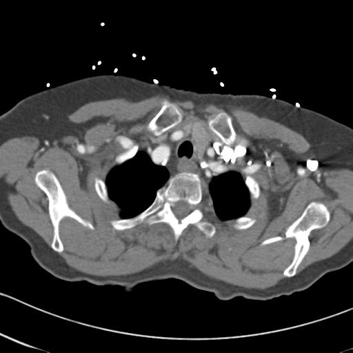 Aortic intramural hematoma from penetrating atherosclerotic ulcer (Radiopaedia 31137-31836 A 7).jpg