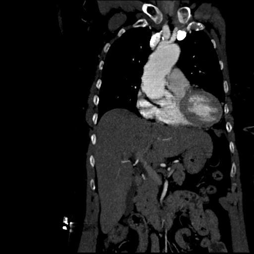 File:Aortic intramural hematoma from penetrating atherosclerotic ulcer (Radiopaedia 31137-31836 C 21).jpg