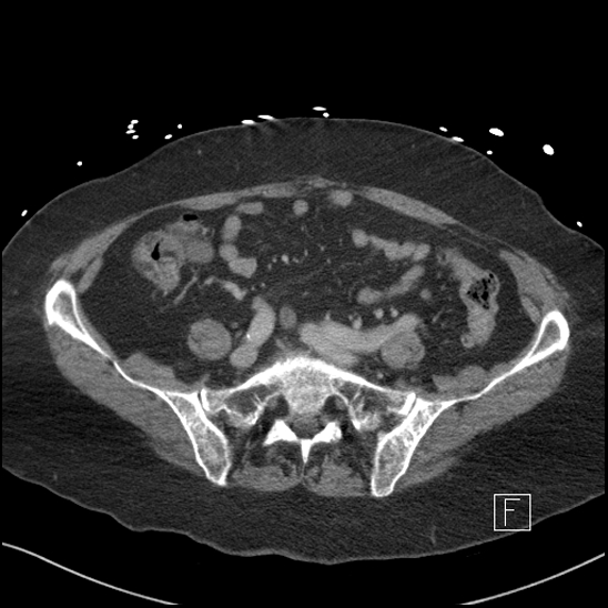 Aortic intramural hematoma with dissection and intramural blood pool (Radiopaedia 77373-89491 E 68).jpg