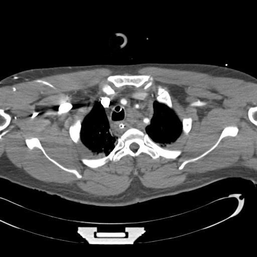 Aortic transection, diaphragmatic rupture and hemoperitoneum in a complex multitrauma patient (Radiopaedia 31701-32622 A 18).jpg