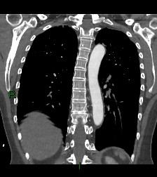File:Aortic valve endocarditis (Radiopaedia 87209-103485 D 21).jpg
