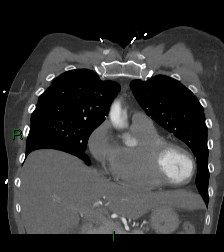 File:Aortic valve endocarditis (Radiopaedia 87209-103485 D 50).jpg