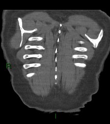 File:Aortic valve endocarditis (Radiopaedia 87209-103485 D 6).jpg