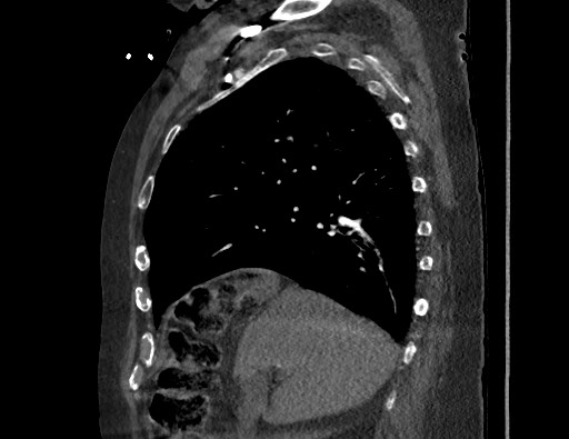 Aortoesophageal fistula with endovascular repair (Radiopaedia 73781-84592 Sagittal C+ CTPA 58).jpg