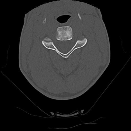 Apical pneumothorax on cervical spine CT (Radiopaedia 45343-49368 Axial bone window 36).jpg