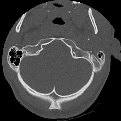 File:Apical pneumothorax on cervical spine CT (Radiopaedia 45343-49368 Axial bone window 5).jpg