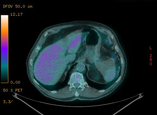 Appendiceal adenocarcinoma complicated by retroperitoneal abscess (Radiopaedia 58007-65041 Axial PET-CT 104).jpg