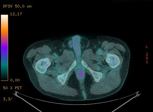 Appendiceal adenocarcinoma complicated by retroperitoneal abscess (Radiopaedia 58007-65041 Axial PET-CT 198).jpg