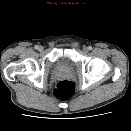 File:Appendicitis and renal cell carcinoma (Radiopaedia 17063-16760 A 56).jpg