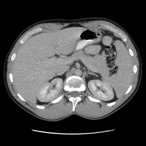 Appendicitis complicated by post-operative collection (Radiopaedia 35595-37113 A 18).jpg