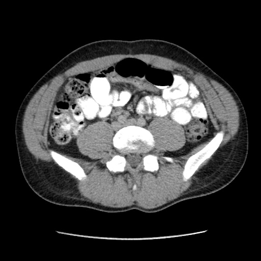 Appendicitis complicated by post-operative collection (Radiopaedia 35595-37113 A 46).jpg