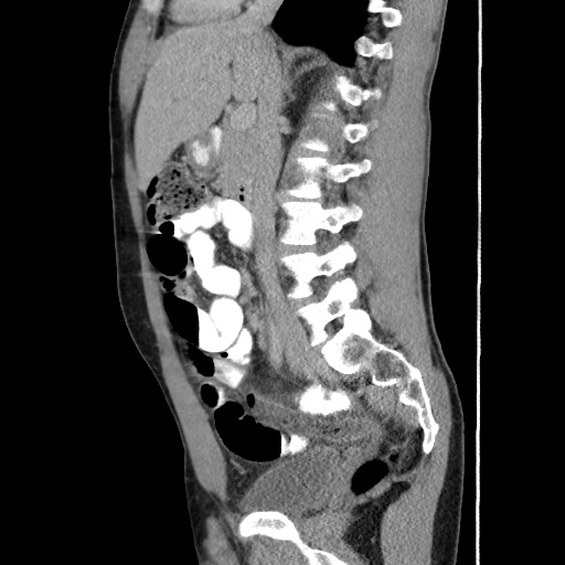 Appendicitis complicated by post-operative collection (Radiopaedia 35595-37114 C 33).jpg