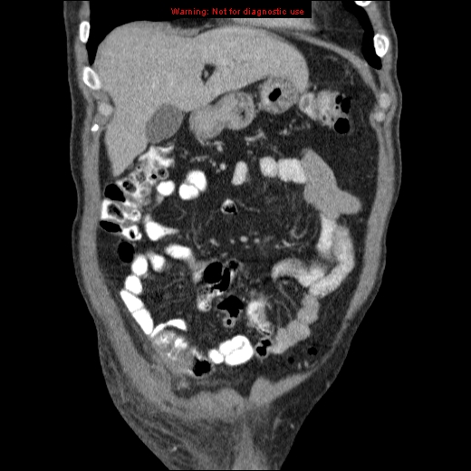 File:Appendicitis mass in inguinal hernia (Radiopaedia 26858-27029 B 15).jpg