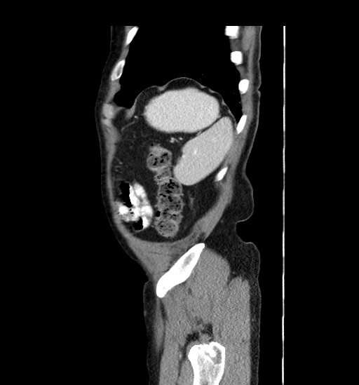 Appendicitis with localized perforation and abscess formation (Radiopaedia 49035-54130 C 57).jpg