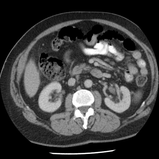Appendicitis with perforation (Radiopaedia 35790-37342 A 21).jpg