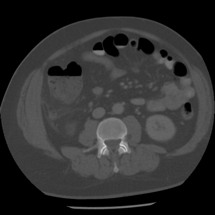 Appendicitis with perforation (Radiopaedia 35790-37342 Axial bone window 27).jpg