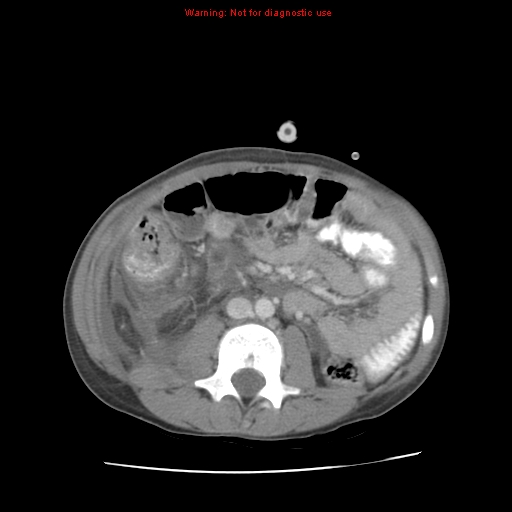 Appendicitis with phlegmon (Radiopaedia 9358-10046 A 38).jpg