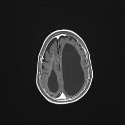 Aqueductal stenosis (Radiopaedia 73974-84802 Axial T1 C+ 121).jpg