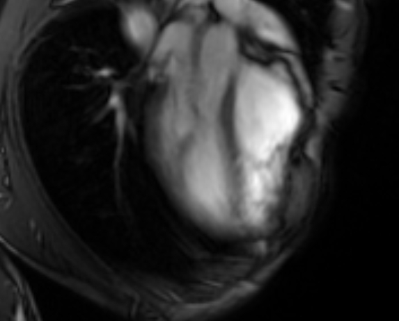 Arrhythmogenic right ventricular cardiomyopathy (Radiopaedia 69564-79464 4ch cine 30).jpg