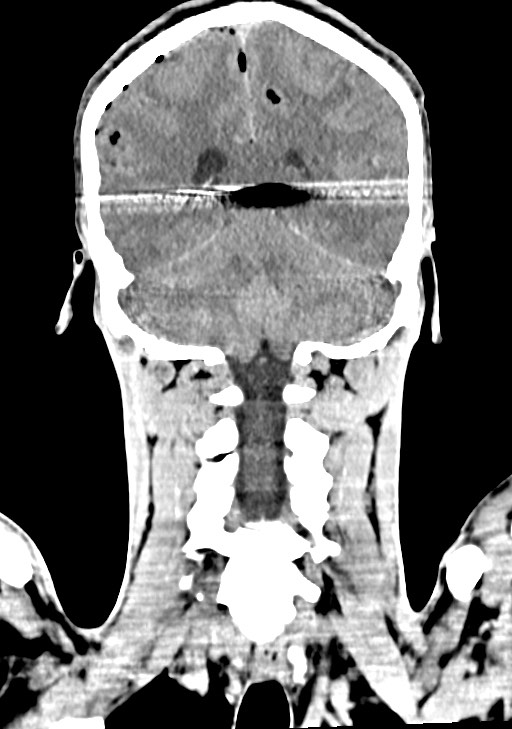Arrow injury to the brain (Radiopaedia 72101-82607 Coronal non-contrast 51).jpg