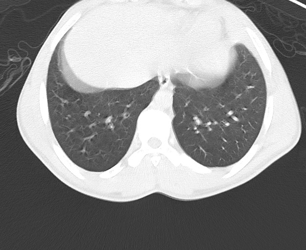 Arrow injury to the chest (Radiopaedia 75223-86321 Axial lung window 74).jpg