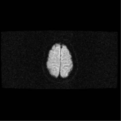 File:Arteriovenous malformation (cerebral) (Radiopaedia 40070-42580 Axial DWI 19).png