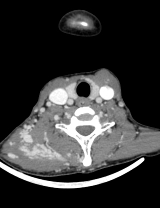 File:Arteriovenous malformation of the neck (Radiopaedia 53935-60062 B 35).jpg