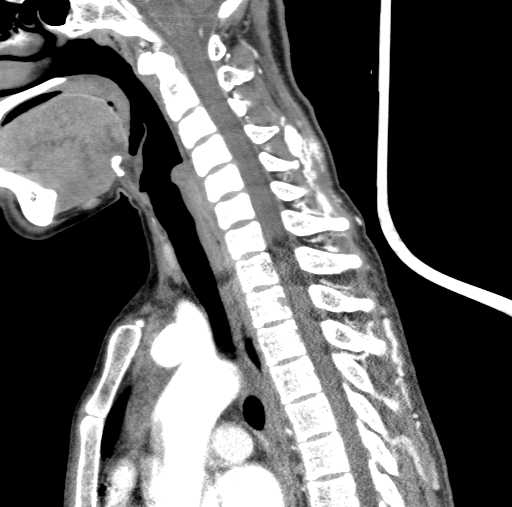 Arteriovenous malformation of the neck (Radiopaedia 53935-60062 C 65).jpg
