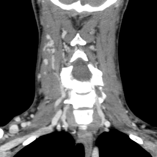 Arteriovenous malformation of the neck (Radiopaedia 53935-60062 D 19).jpg