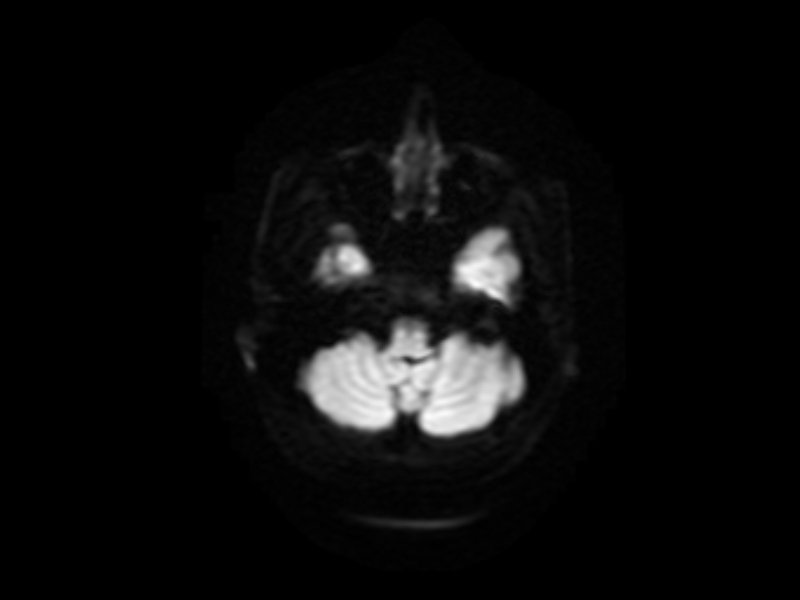 File:Artery of Percheron infarct (Radiopaedia 36897-38526 Axial DWI 2).jpg