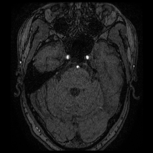 Artery of Percheron infarction (Radiopaedia 27975-28230 3D TOF 57).jpg