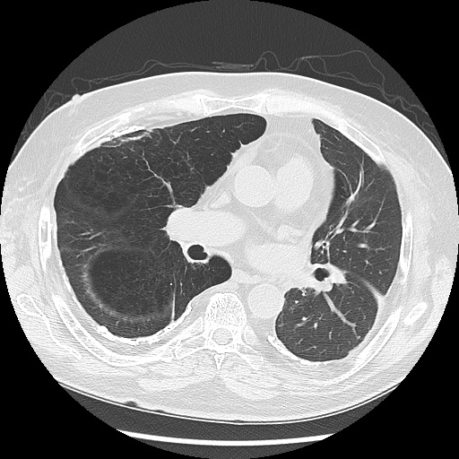 Asbestos-related pleural disease (Radiopaedia 74366-85250 Axial lung window 59).jpg