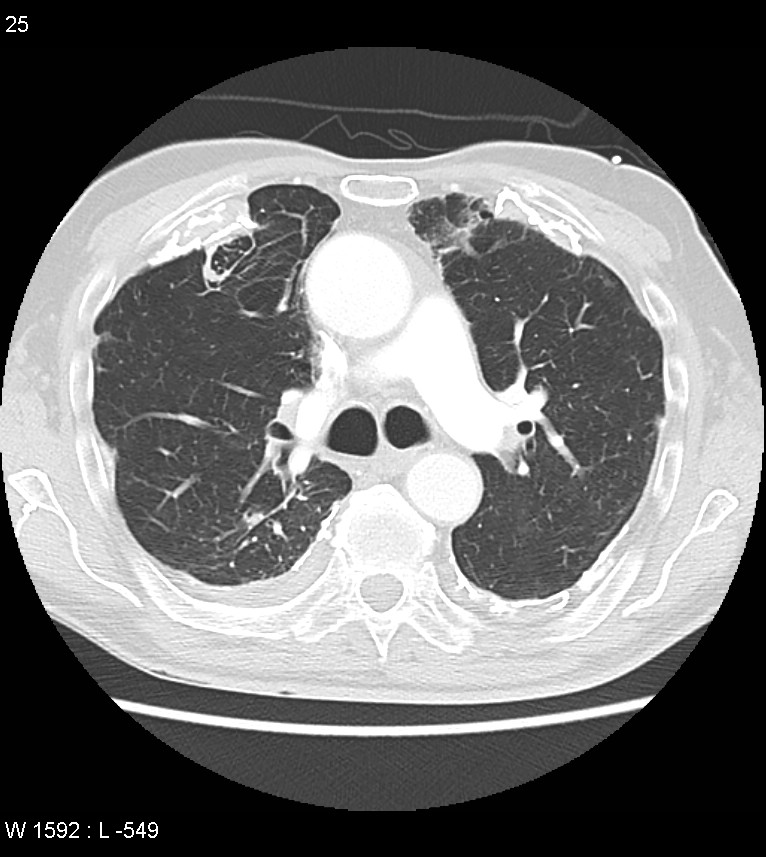 Asbestos related lung and pleural disease (Radiopaedia 14377-14301 A 22).jpg