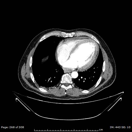 Ascending aortic aneurysm (Radiopaedia 50086-55404 A 70).jpg