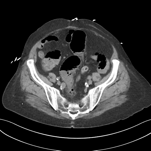 File:Ascending cholangitis (Radiopaedia 39068-41253 Axial non-contrast 50).png