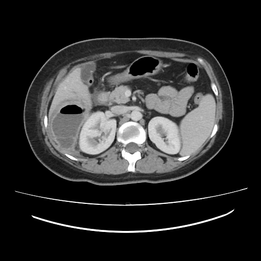 Ascending retrocecal appendicitis with liver abscesses (Radiopaedia 60066-67615 B 34).jpg