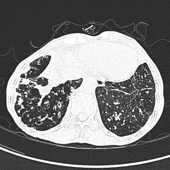 Aspergilloma- with Monod sign (Radiopaedia 44737-48532 Axial lung window 246).jpg