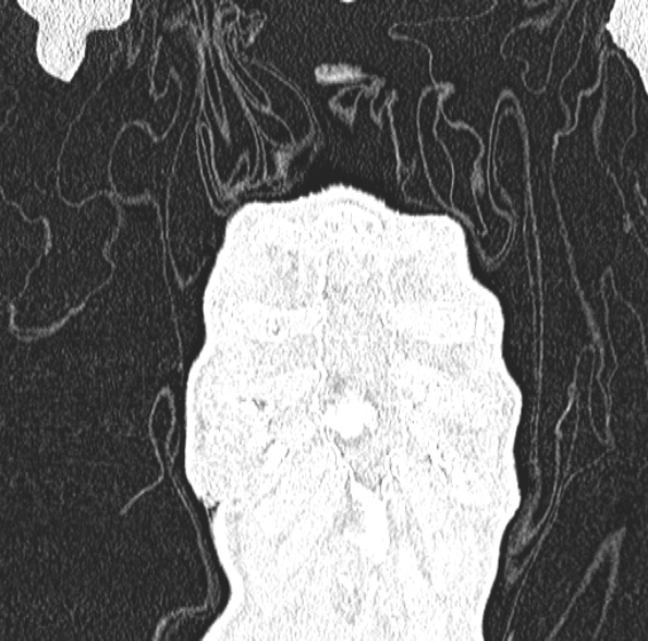 File:Aspergilloma- with Monod sign (Radiopaedia 44737-48532 Coronal lung window 117).jpg