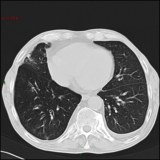 File:Aspergilloma (Radiopaedia 14842-14787 Axial lung window 33).jpg