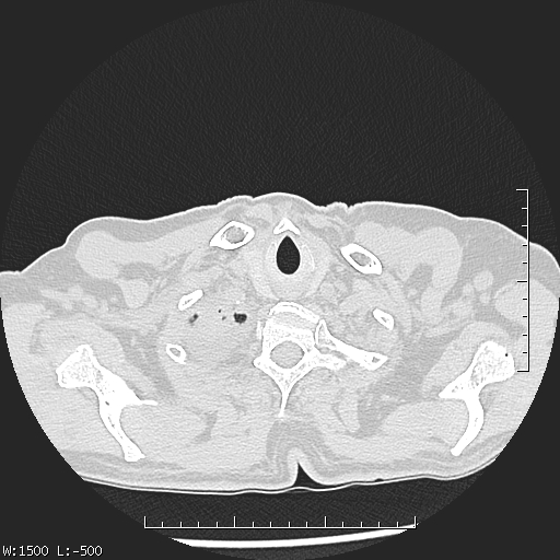 Aspergilloma (Radiopaedia 75184-86270 Axial lung window 3).jpg