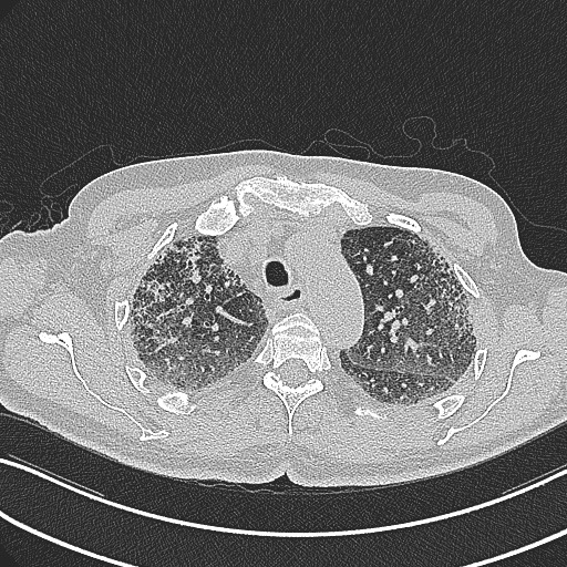 File:Aspergilloma on background pulmonary fibrosis (Radiopaedia 60942-68757 B 15).jpg