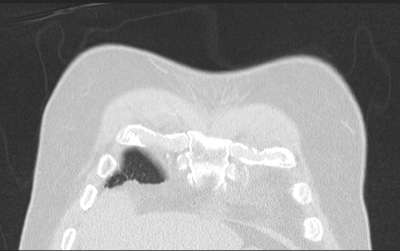 Aspirated tooth (Radiopaedia 28584-28844 Axial lung window 25).jpg