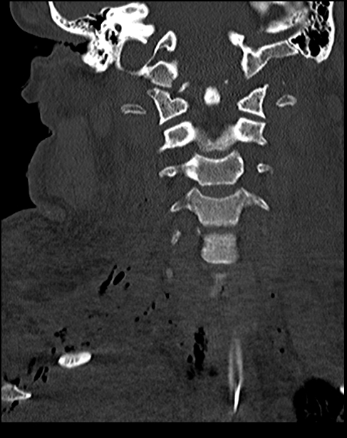 Atlanto-occipital dissociation - Traynelis type 1 (Radiopaedia 87570-103948 Coronal bone window 30).jpg