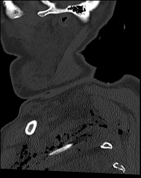 Atlanto-occipital dissociation - Traynelis type 1 (Radiopaedia 87570-103948 Sagittal bone window 14).jpg