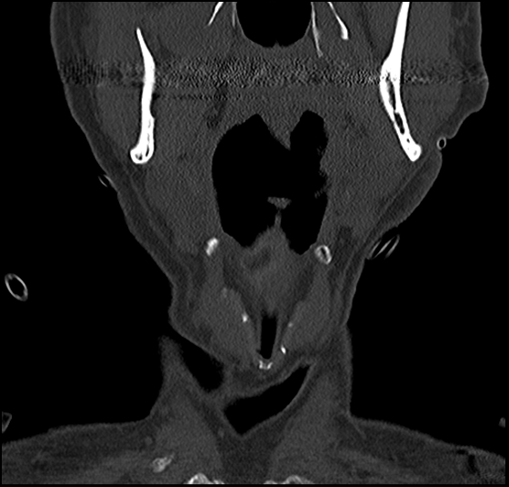 Atlas (type 3b subtype 1) and axis (Anderson and D'Alonzo type 3, Roy-Camille type 2) fractures (Radiopaedia 88043-104607 Coronal bone window 4).jpg