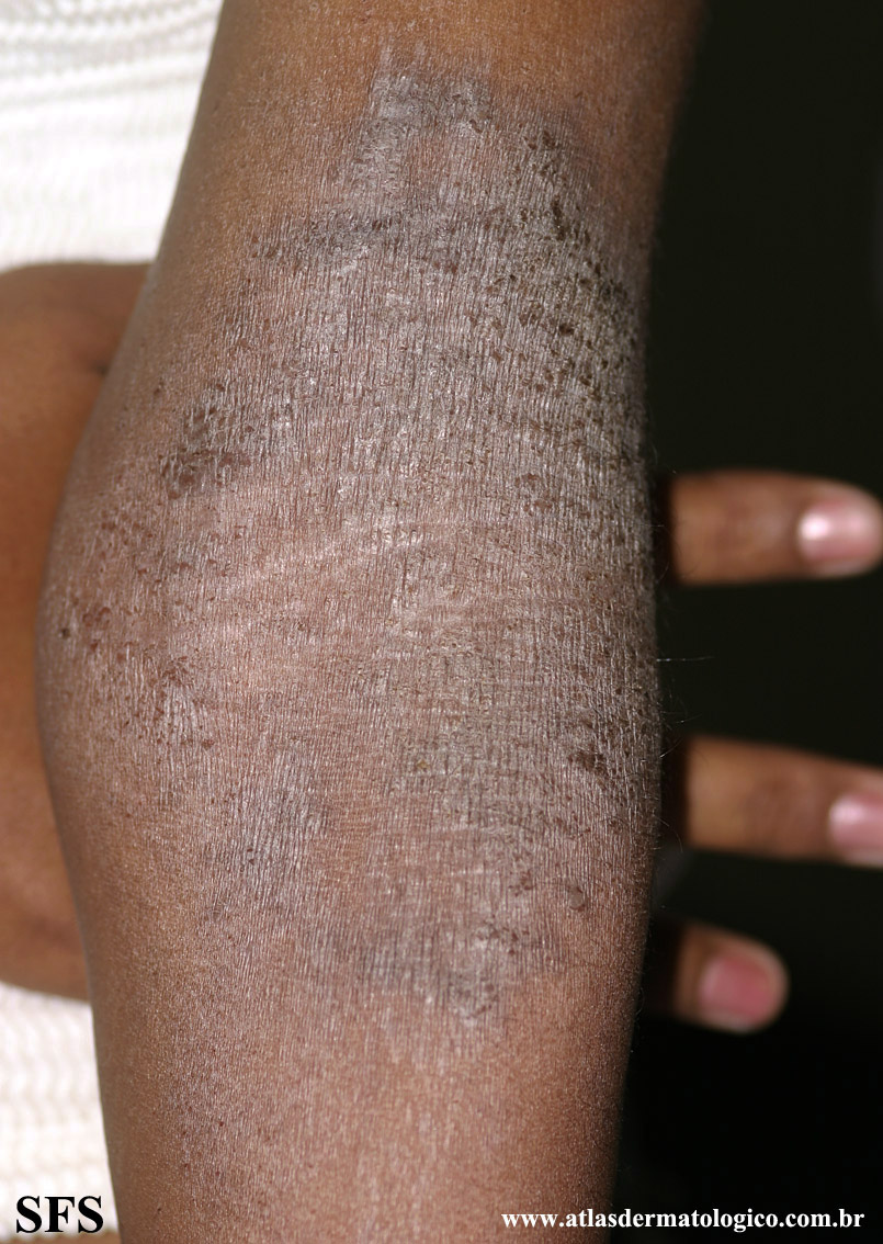 Atopic Dermatitis (Dermatology Atlas 44).jpg
